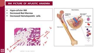 Hematology  1  U9L2  BM of aplastic anaemia [upl. by Eelame415]