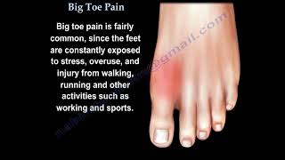 Big Toe Pain  Everything You Need To Know  Dr Nabil Ebraheim [upl. by Ayt]