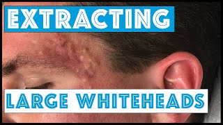 Acne Vulgaris and Extracting large Whiteheads  Part 1 [upl. by Lyndsay]