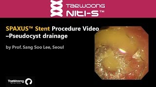 Niti S™ Gastrointestinal Metal Stent SPAXUS™ Stent Procedure videoPseudocyst drainage [upl. by Leksehcey]