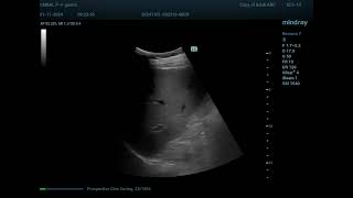 Adrenal Gland Ultrasound Normal Vs Abnormal Image Appearances  Cyst Adenoma Pheochromocytoma USG [upl. by Decker]