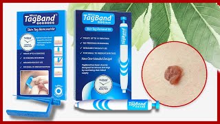 How To Remove Skin Tags ❘ TagBand Skin Tag Remover [upl. by Kraus582]