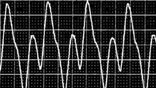 An introduction to Intra aortic balloon pumping [upl. by Perpetua316]