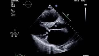 Mitral Stenosis Rheumatic Heart Disease ParaSternal Long mitral valve [upl. by Trent]