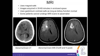 Understanding the Radiology Report to Diagnose Treat and Monitor Brain Tumors [upl. by Ainwat]