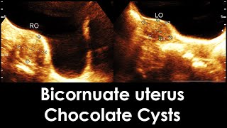 Practical ultrasound case of Bicornuate uterus  Endometriosis  Chocolate Cysts  Nabothian cyst [upl. by Helbonnah558]