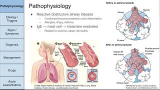 Asthma [upl. by Eamon]