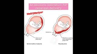 Placenta previa Cesarean sectiondoctor anatomy obstetrician nursing medicalstudent [upl. by Oilisab282]