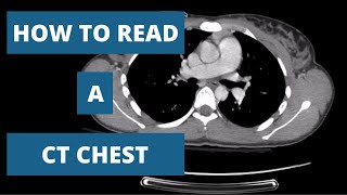 How to Read a CT Scan Chest  A Radiologists Approach [upl. by Sidwel638]