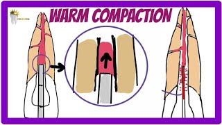 ENDODONTICS  OBTURATION TECHNIQUES  Warm Vertical Compaction technique [upl. by Marcin]