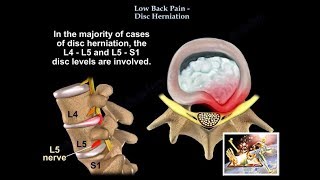 Low Back Pain  Disc Herniation  Everything You Need To Know  Dr Nabil Ebraheim [upl. by Honorine634]