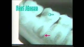 1241 Root Abscess  Dental Xrays  Dr Vaidya [upl. by Paquito]