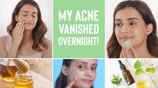 How To Make Your Acne Disappear Overnight  4 Home Remedies For Pimples [upl. by Bulley588]