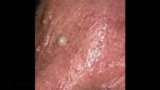 Milia Extraction amp Cherry Angioma Removal with Electrolysis [upl. by Mason]