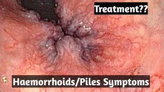 HaemorrhoidsPiles treatment what are its symptoms [upl. by Ahsaercal216]