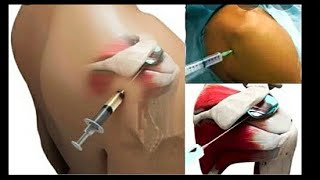 5 seconds trick to get pain free shoulderFrozen shoulderIntraarticular injection technique [upl. by Yelsnik680]