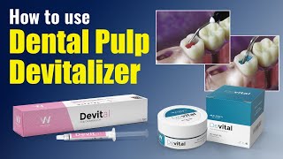 How to use Dental Pulp Devitalizer  Waldent Devital [upl. by Jerrine]