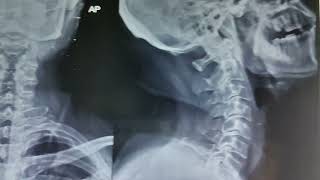 Cervical Spondylosis on Xray [upl. by Akit]