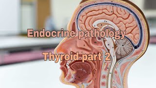 Endocrine pathology Thyroid gland part 2 [upl. by Aliban685]