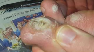 Plantar wart removing part 4 22  Dornwarze entfernen Teil 4 22 [upl. by Kylila189]