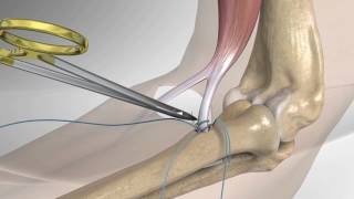 High Power Laser Therapy for Low Back Pain Deep Tissue Laser [upl. by Gazo231]