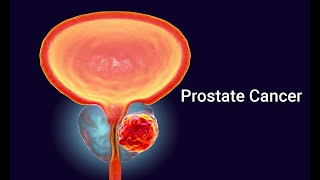 prostate cancer 5 biopsy technique Gleason pattern Gleason score grading system and staging [upl. by Anawk596]