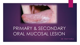 Oral Pathology  Mucosal Reactive Lesions  INBDE ADAT [upl. by Howard37]