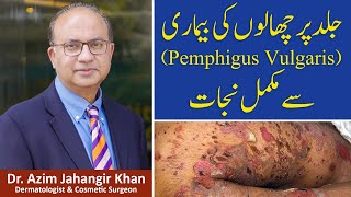 What is Pemphigus Vulgaris  Skin disease  Happy Patient  Prof Dr Azim  Cosmetique [upl. by Bonacci]