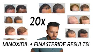 20 Finasteride and Minoxidil before and after Results NW2  NW56 [upl. by Haroun]