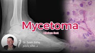 13 Mycetoma Madura foot [upl. by Adnolaj692]