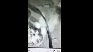 Syndrome de Cockett thrombose veine iliaque gauche thrombolyse et angioplastie avec stent [upl. by Anetta]