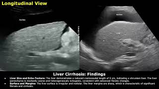 Liver Cirrhosis With Portal Hypertension Ascites amp Splenomegaly Ultrasound Report Example  USG [upl. by Guenna]