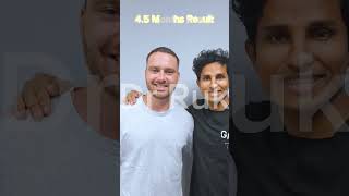 Austin Gosney Shammi hair transplant surgery journey Dr Ruk hairtransplantbeforeafter prank [upl. by Arza]