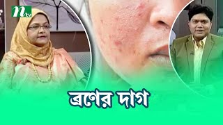 মুখে ব্রণের কালো দাগ থেকে মুক্তির উপায় । Health Show  স্বাস্থ্য প্রতিদিন [upl. by Annagroeg306]