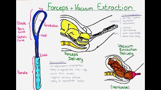 Forceps vs Vacuum Extraction Delivery Ventouse Understanding the Difference Procedures and Risks [upl. by Nitsrek]