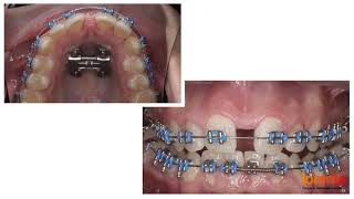 Evolución del tratamiento de ortodoncia con brackets en menos de 1 minuto [upl. by Bardo]