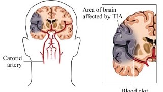 Transient Ischemic Attack TIA [upl. by Tobi]