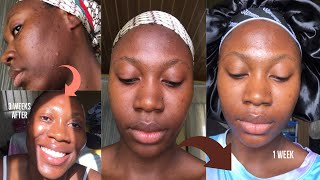 Kojie San kojic acid skin lightening Soap  3 weeks honest Review with before and after [upl. by Ylaek]