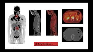 DES lymphome de Hodgkin  place de la TEP dans la prise en charge  AnneSégolène Cottereau [upl. by Elleinwad124]