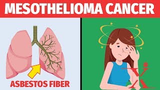 Mesothelioma Shocking Signs amp Symptoms [upl. by Theurich932]