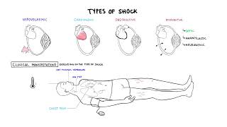 Approach to Shock  types hypovolemic cardiogenic distributive anaphylaxis pathology treatment [upl. by Glogau831]