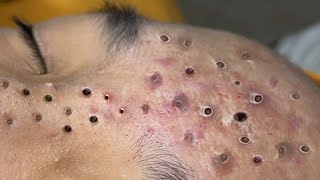 Loan Nguyen Acne Treatment 11 [upl. by Sllew]