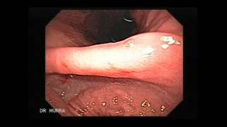 Video clip of an Upper Endoscopy [upl. by Ryon377]