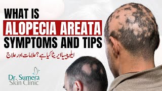 What is Alopecia Areata Symptoms and Tips for Curing Balding  Dr Sumera Rashid alopecia [upl. by Solitta]