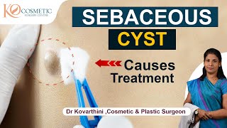 Sebaceous cyst Removal infections and treatment  Ko Cosmetic Surgery Centre  Dr Kovarthini [upl. by Martineau]