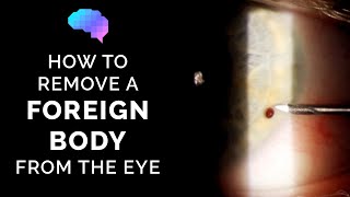 How to Remove a Foreign Body from the Eye  Eye Injury  OSCE Guide  UKMLA  CPSA  PLAB 2 [upl. by Ingaberg458]