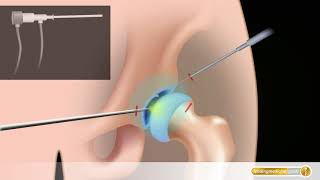 HüftArthroskopie So läuft eine Gelenkspiegelung der Hüfte ab [upl. by Attirb916]