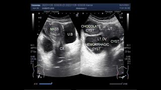 Three types of Ovarian cysts with Fibroids in the same patient [upl. by Hermia705]