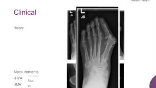 Hallux Valgus Rigidus by Dr Marc Friso [upl. by Mark]