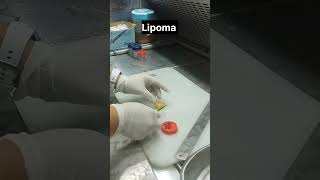 lipoma lipomatreatment [upl. by Higgins]